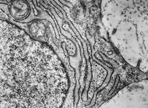 M,19y. | chondrocyte - chondrosarcoma - jaw M,19y. | chondrocyte - chondrosarcoma - jaw